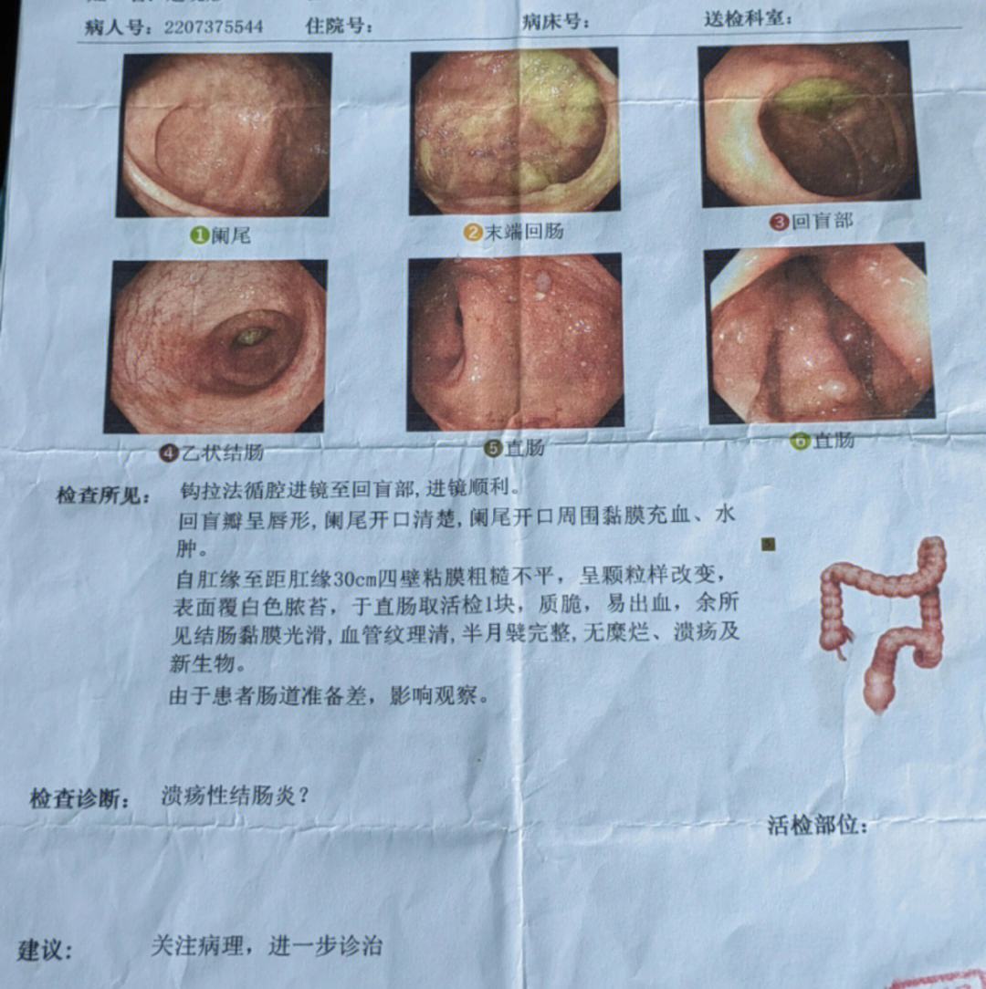 克罗恩病和溃疡性结肠炎的区别是什么(克罗恩病和溃疡性结肠炎治疗 *** 一样吗)  第2张